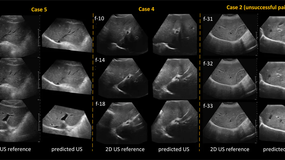 Deep Regression 2D-3D Ultrasound Registration for Liver Motion Correction for Focal Tumor Thermal Ablation