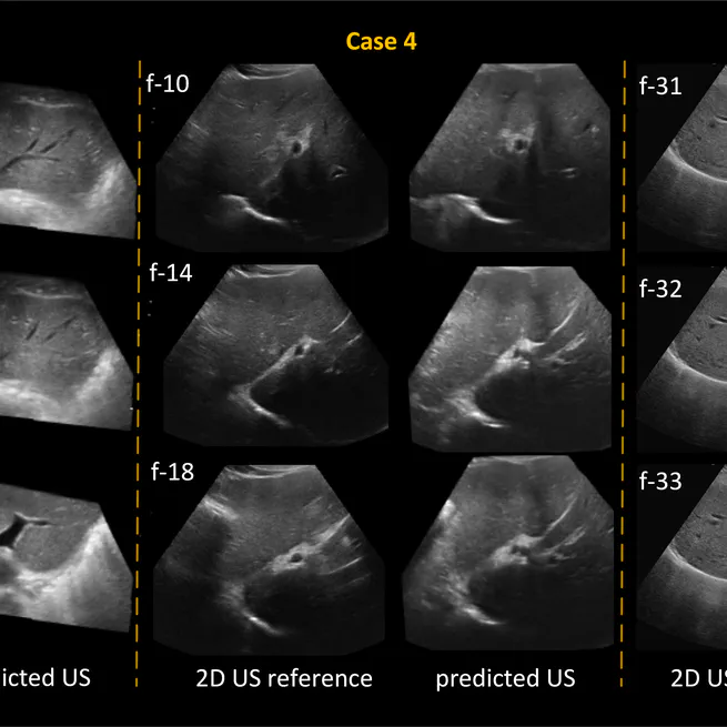 Deep Regression 2D-3D Ultrasound Registration for Liver Motion Correction for Focal Tumor Thermal Ablation