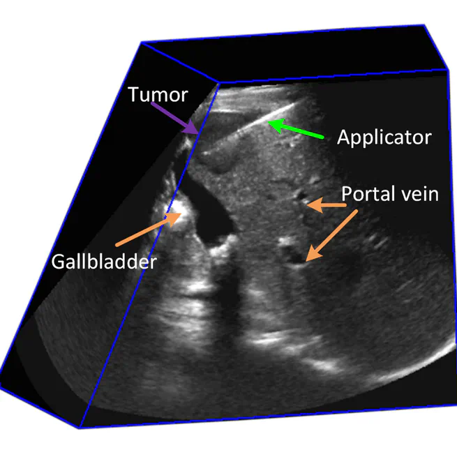 Intra-procedural evaluation of tumor coverage using 3D US images for percutaneous focal liver thermal ablation