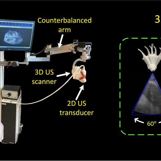 A 2D/3D US/CT-guided system for percutaneous focal liver thermal ablation